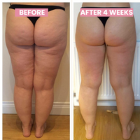 Anti-Cellulite-Cupping-Gerät – SlimCupp